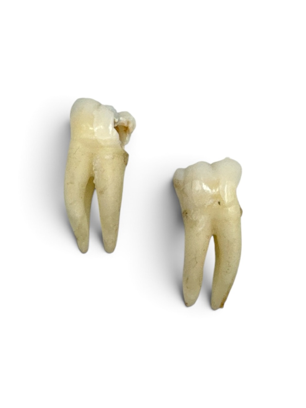 Real Human Adult Molar Tooth Anatomical Specimen with Filling Oddity